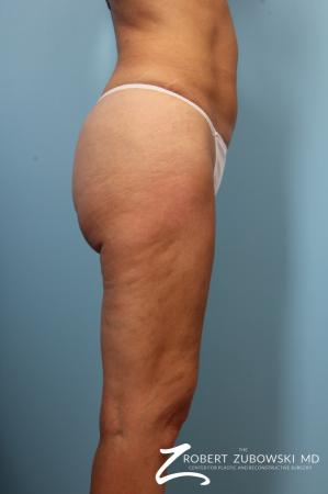 Cellulaze: Patient 1 - After Image 3