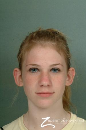 Otoplasty: Patient 5 - Before Image 1