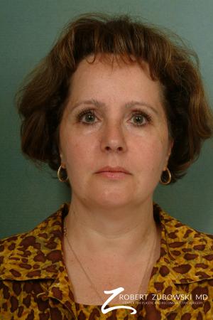 Neck Lift: Patient 8 - Before Image 1