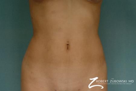 Liposuction: Patient 32 - After Image 1