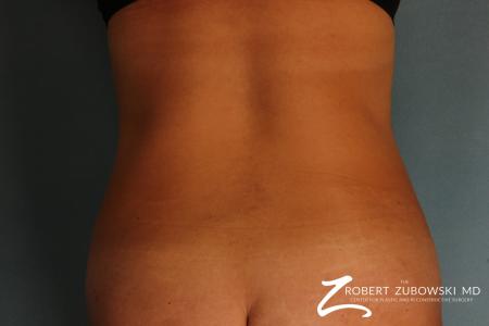 Liposuction: Patient 20 - After Image 1