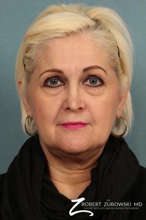 Blepharoplasty: Patient 26 - Before Image 1