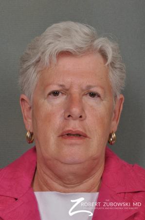 Blepharoplasty: Patient 24 - Before Image 1