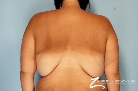 Body Lift: Patient 6 - Before Image 1