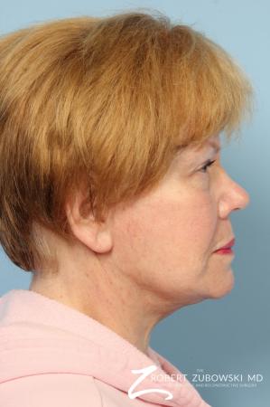 Facelift: Patient 26 - After Image 2