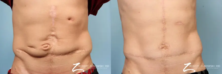 Scar Revision: Patient 2 - Before and After  