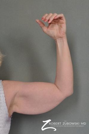 Arm Lift: Patient 1 - Before Image 1