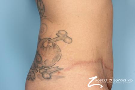 Tummy Tuck: Patient 3 - After Image 2