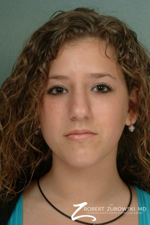 Rhinoplasty: Patient 12 - After Image 1