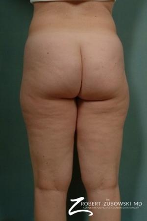 Liposuction: Patient 4 - Before and After Image 2