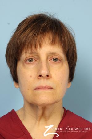Blepharoplasty: Patient 14 - Before Image 1