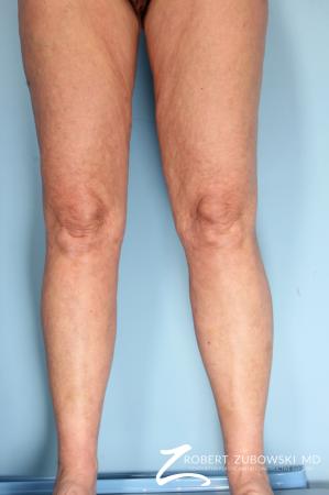 Liposuction: Patient 46 - After Image 2