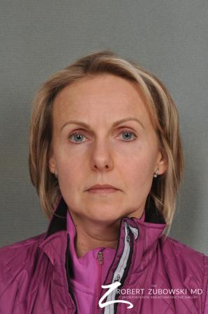 BOTOX® Cosmetic: Patient 2 - Before Image 1