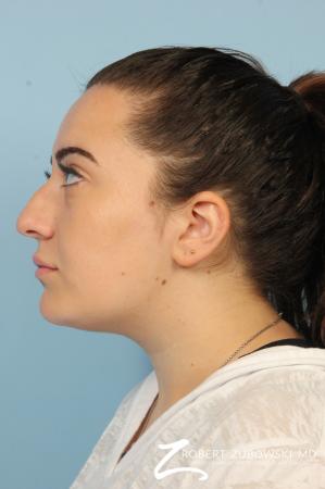 Rhinoplasty: Patient 21 - Before Image 2