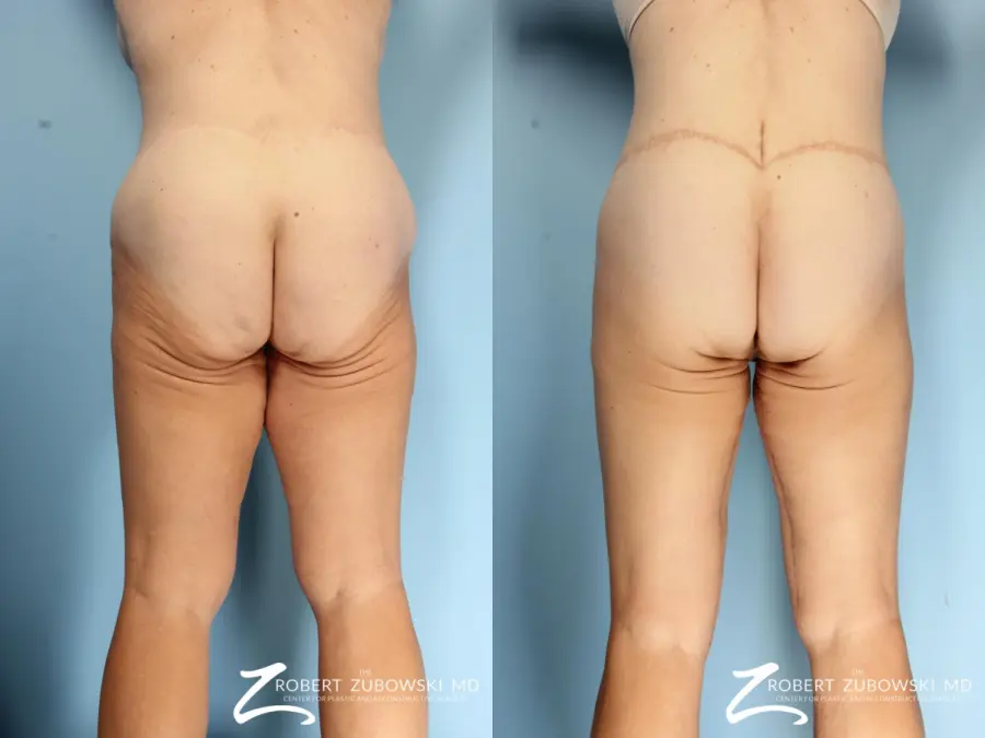 Thigh Lift: Patient 1 - Before and After 2