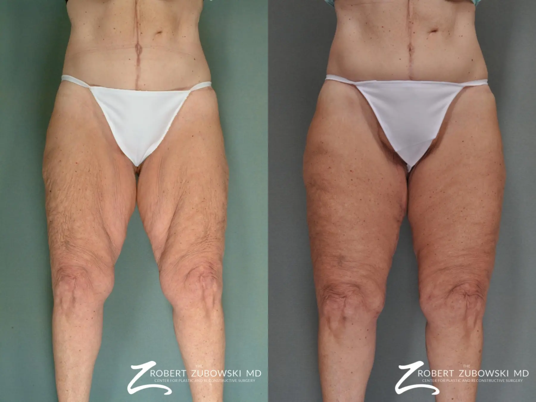 Thigh Lift: Patient 2 - Before and After  