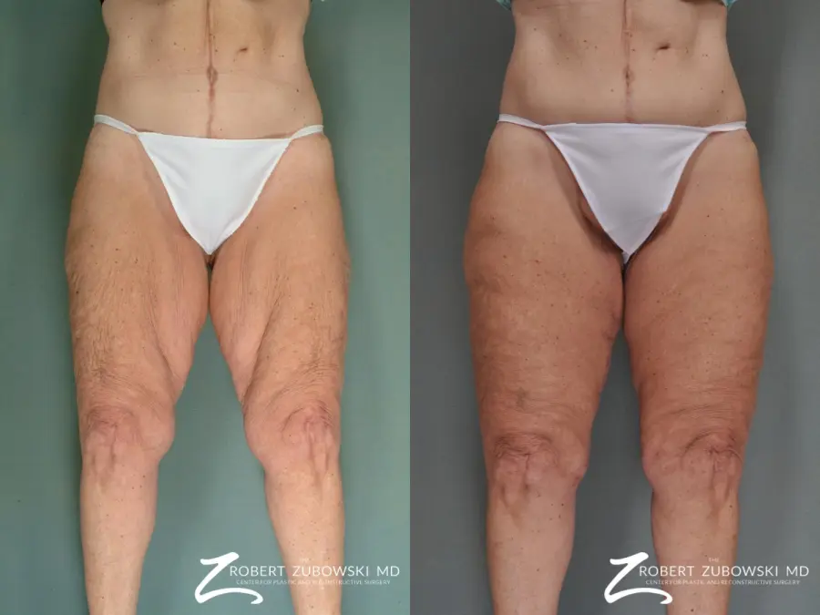 Thigh Lift: Patient 2 - Before and After 1