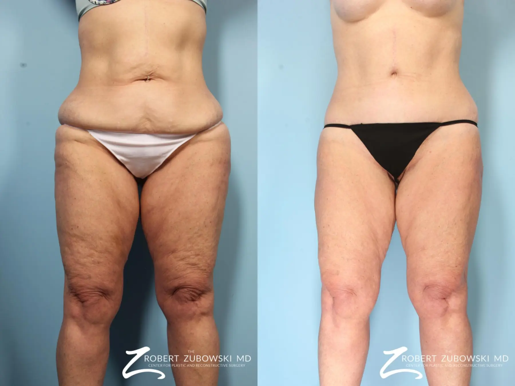 Thigh Lift: Patient 5 - Before and After  