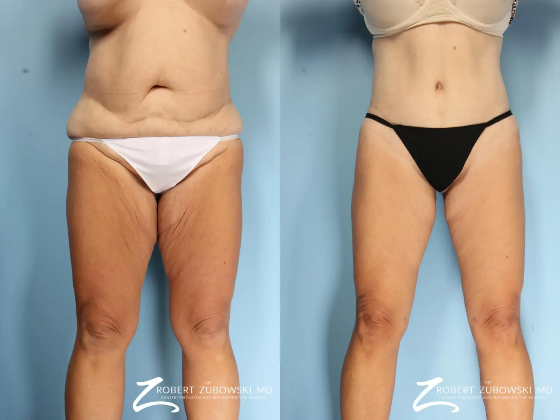 Thigh Lift: Patient 1 - Before and After  