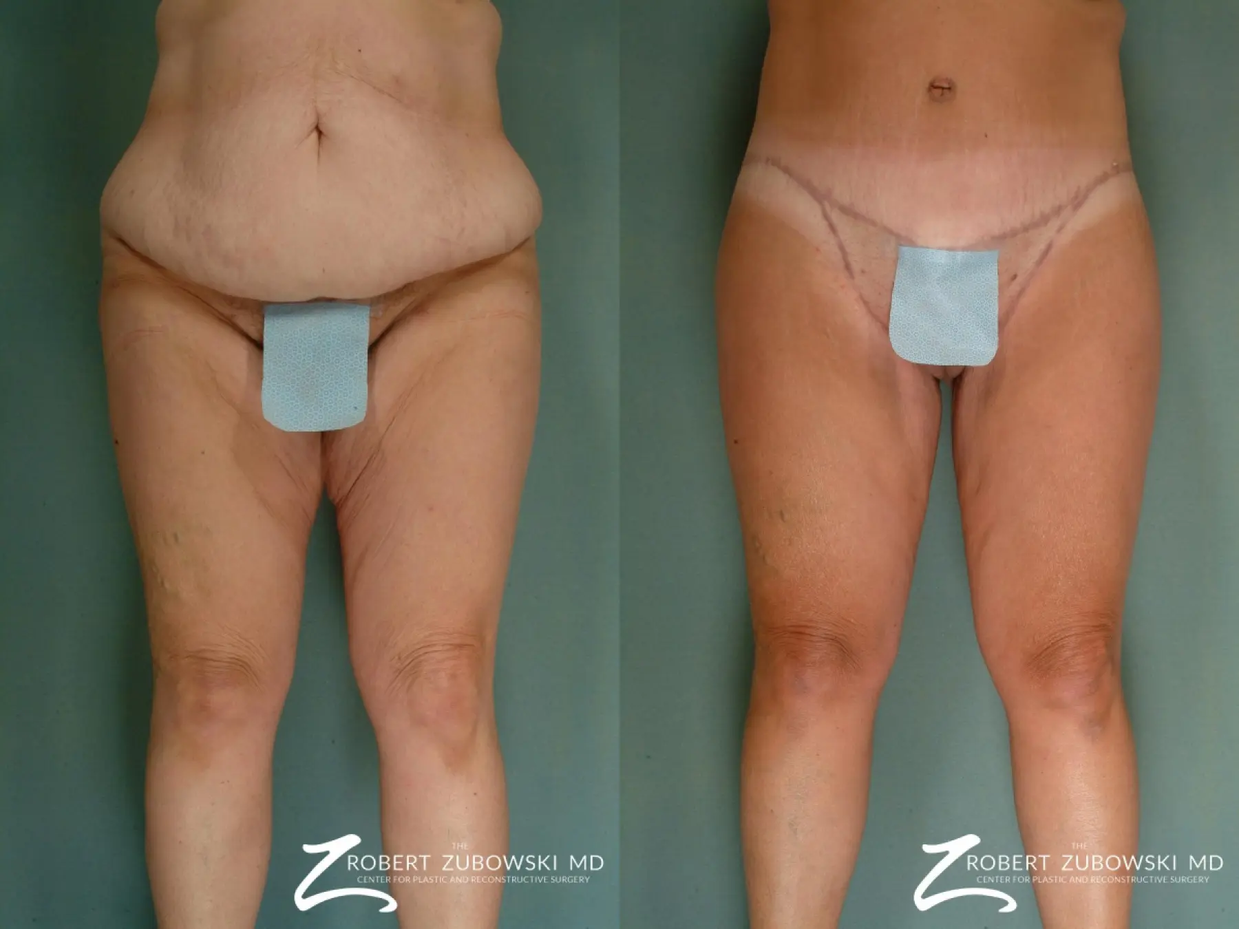 Thigh Lift: Patient 4 - Before and After  