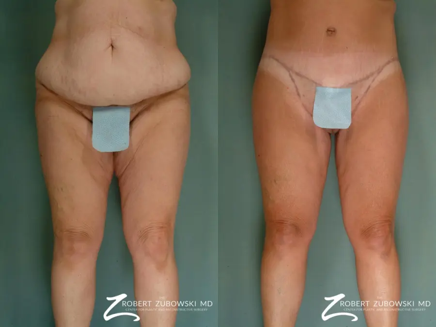 Thigh Lift: Patient 3 - Before and After  