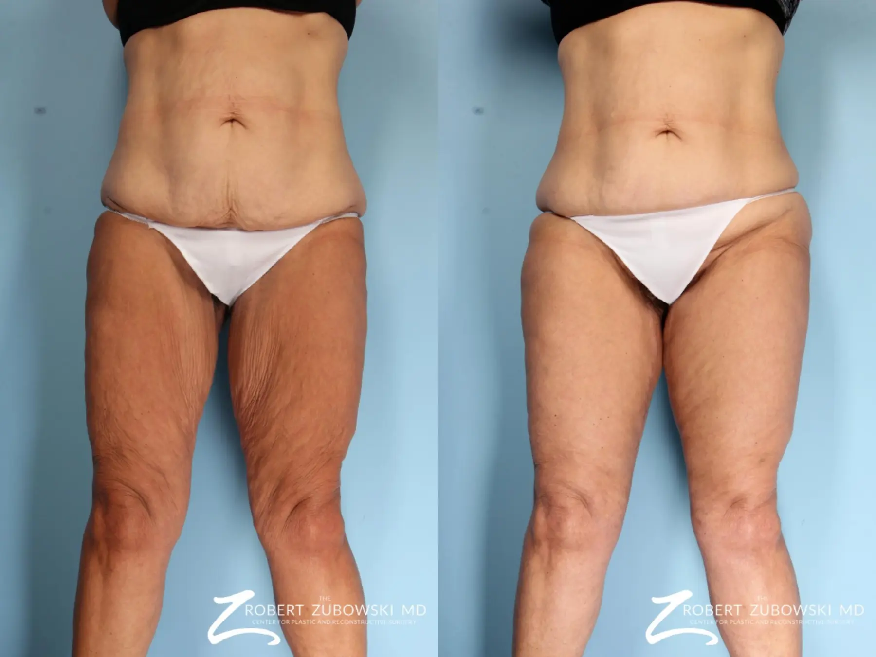 Thigh Lift: Patient 3 - Before and After 1