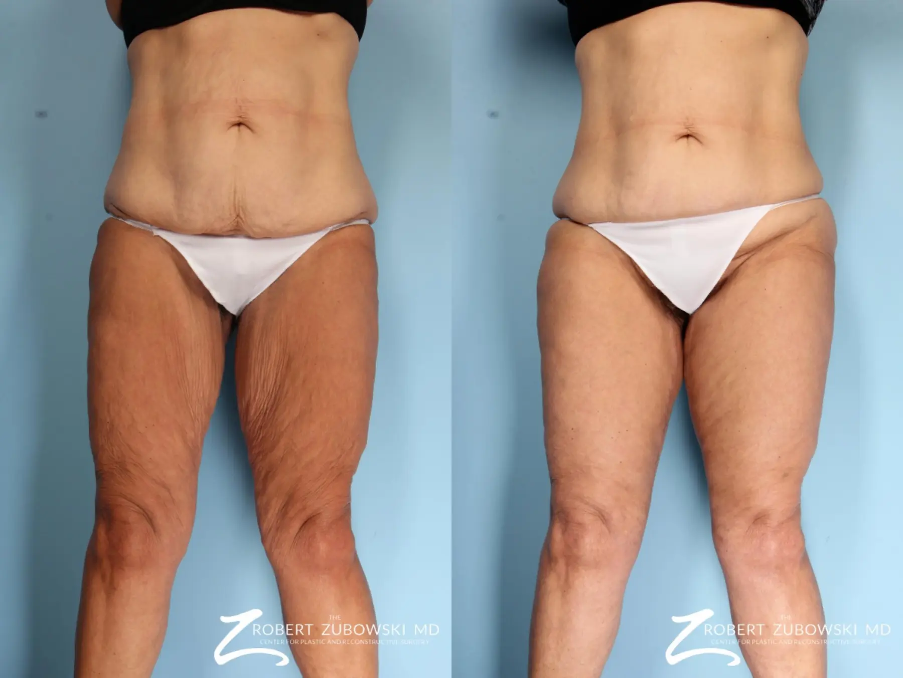 Thigh Lift: Patient 3 - Before and After  