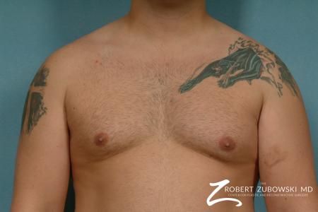 Gynecomastia: Patient 9 - Before Image 1