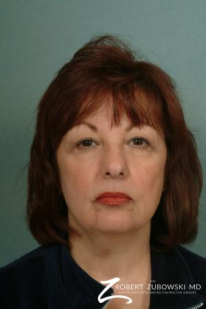 Facelift: Patient 2 - Before Image 1
