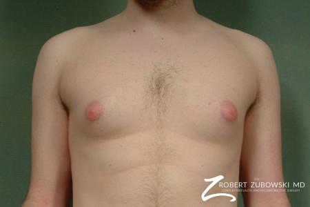 Gynecomastia: Patient 4 - Before Image 1