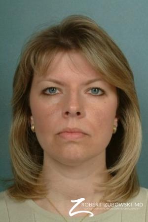 Blepharoplasty: Patient 7 - Before Image 1