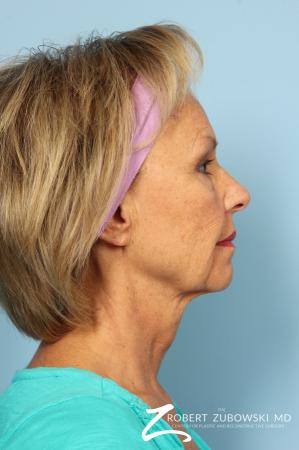 Facelift: Patient 3 - Before Image 2