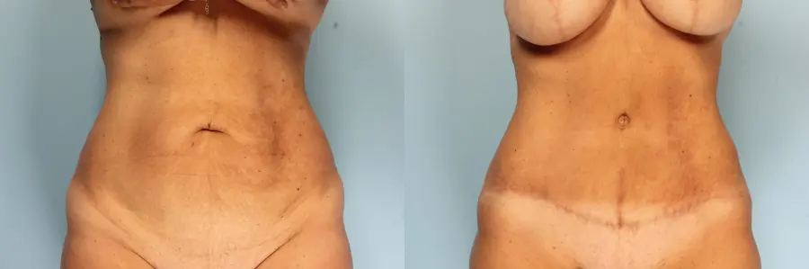 Tummy Tuck: Patient 23 - Before and After  
