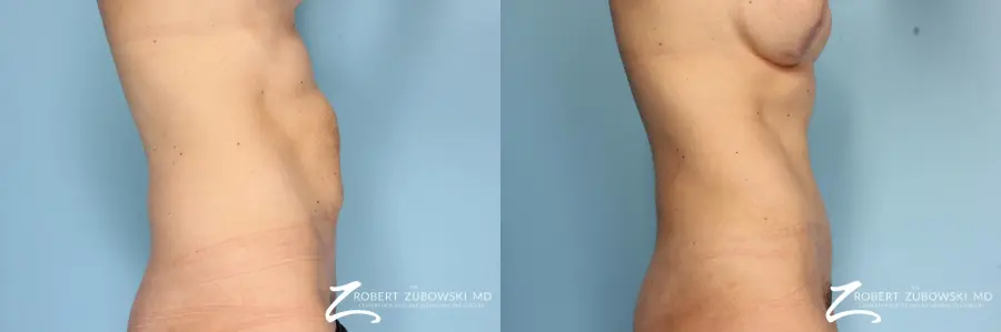 Tummy Tuck: Patient 8 - Before and After 2
