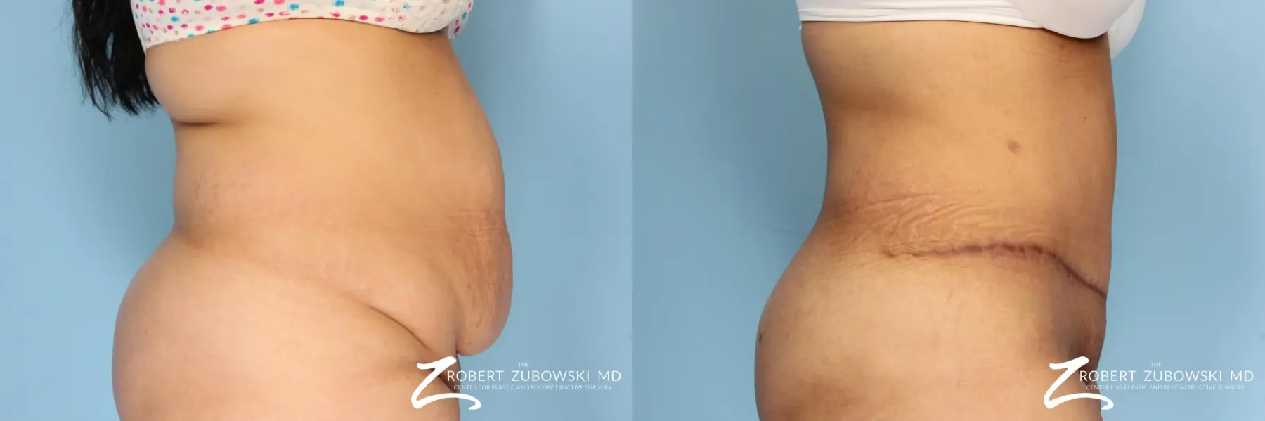 Tummy Tuck: Patient 15 - Before and After 2