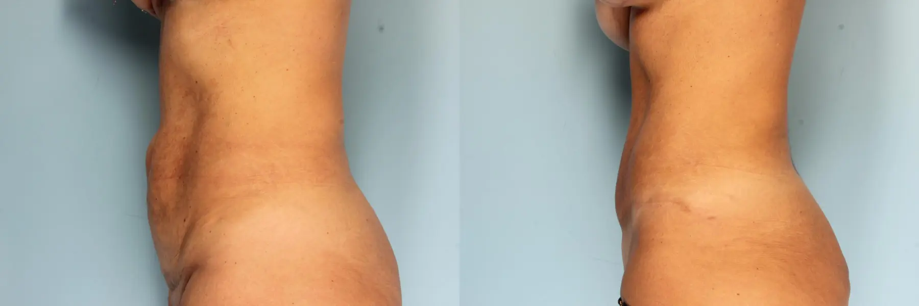 Tummy Tuck: Patient 23 - Before and After 3