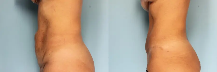 Tummy Tuck: Patient 23 - Before and After 3