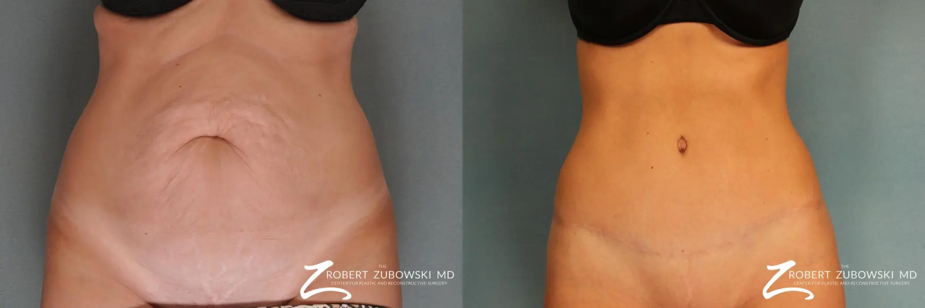 Tummy Tuck: Patient 12 - Before and After 1