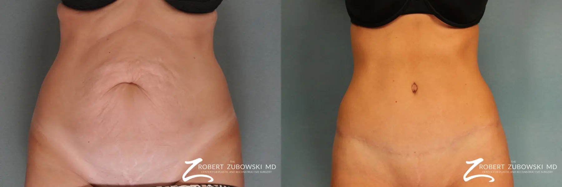 Tummy Tuck: Patient 12 - Before and After  