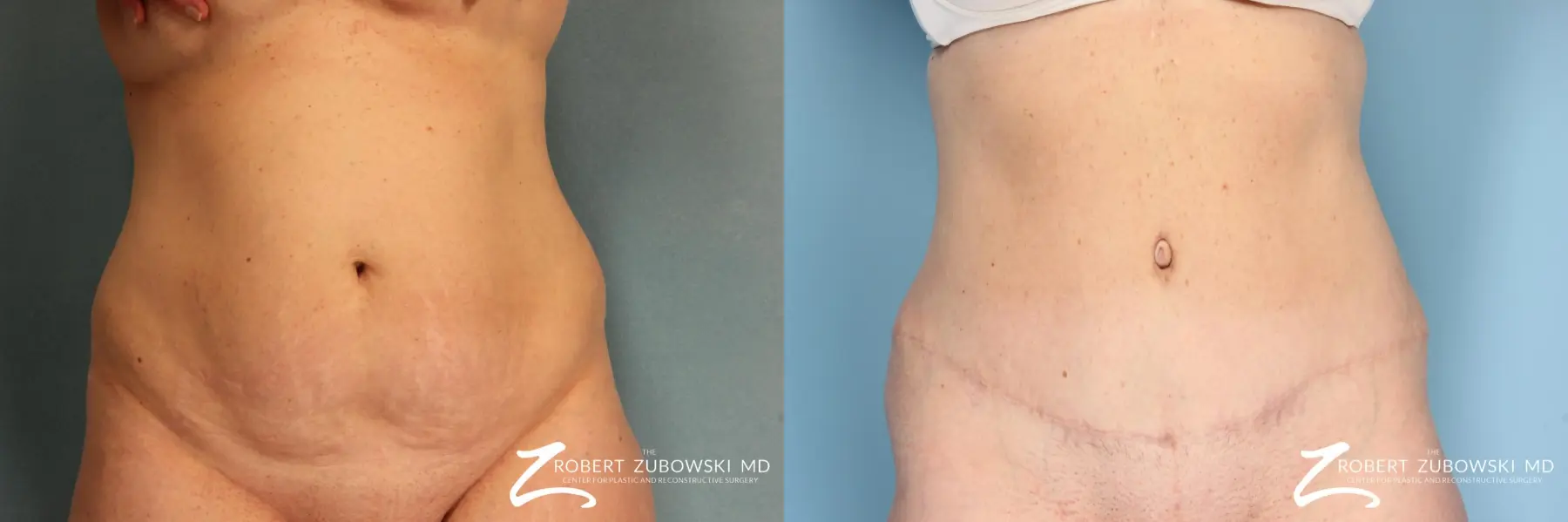 Tummy Tuck: Patient 13 - Before and After  