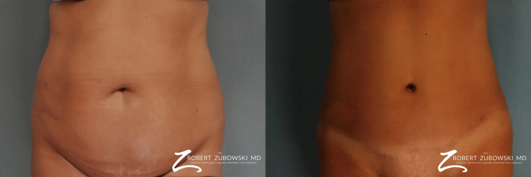 Tummy Tuck: Patient 21 - Before and After  