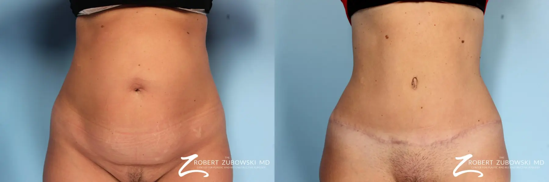 Who Is a Candidate for a Tummy Tuck?: Advanced Plastic Surgery Center:  Plastic and Reconstructive Surgeons