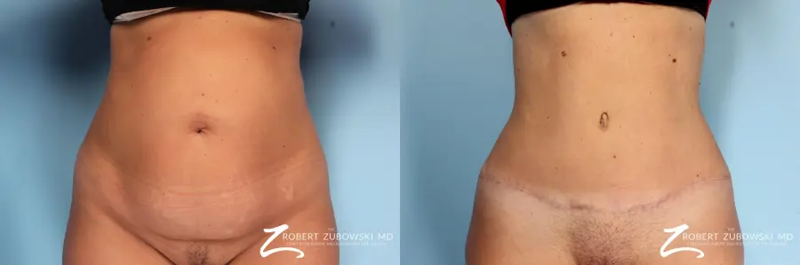 Tummy Tuck: Patient 9 - Before and After  