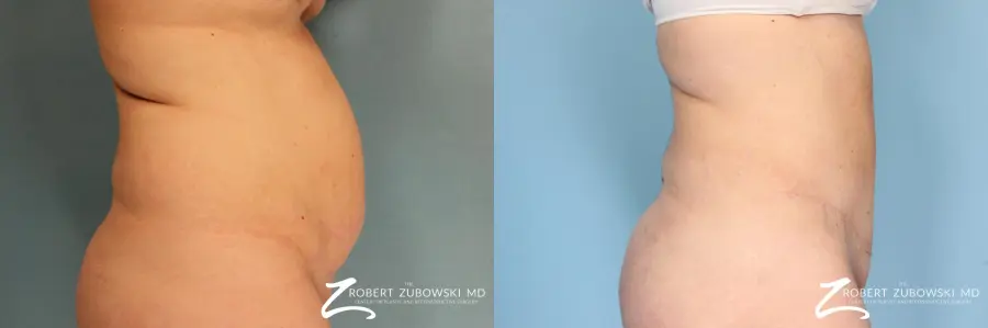 Tummy Tuck: Patient 13 - Before and After 2