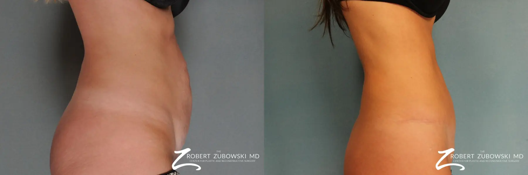 Tummy Tuck: Patient 12 - Before and After 2