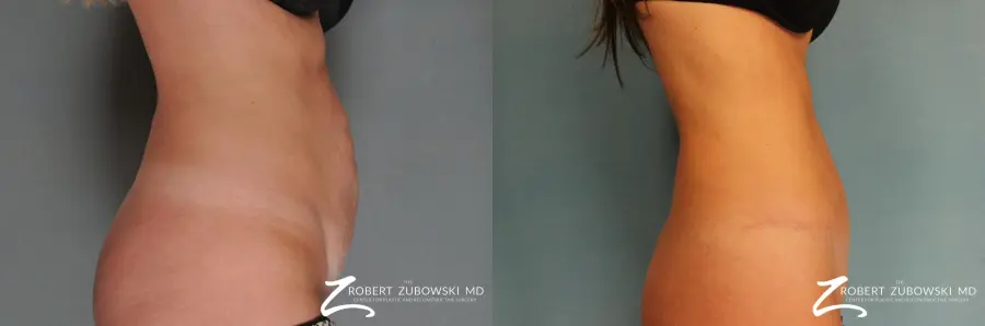 Tummy Tuck: Patient 12 - Before and After 2