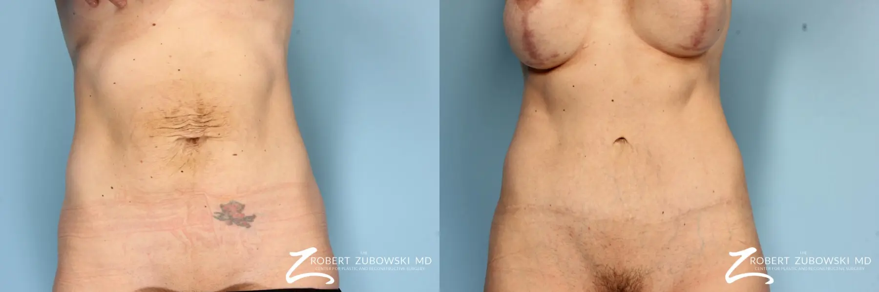 Tummy Tuck: Patient 8 - Before and After  