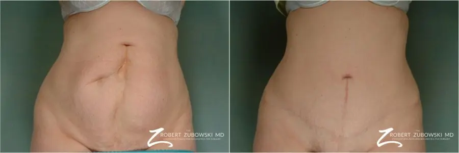 Tummy Tuck: Patient 22 - Before and After 1
