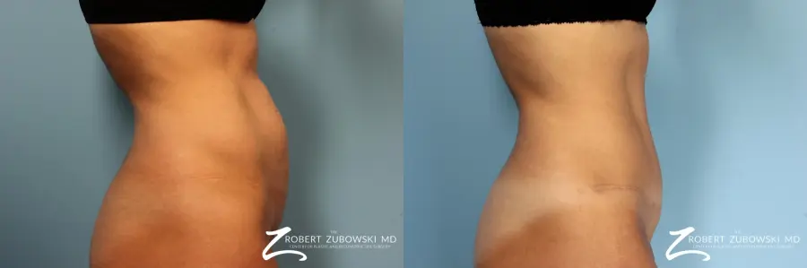 Tummy Tuck: Patient 14 - Before and After 2