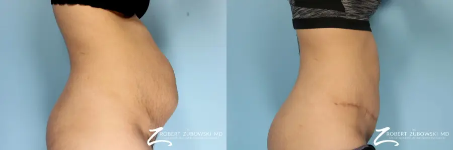 Tummy Tuck: Patient 24 - Before and After  